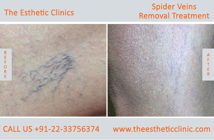 Spider Veins Removal Varicose Veins Laser Treatment before after photos mumbai india (1